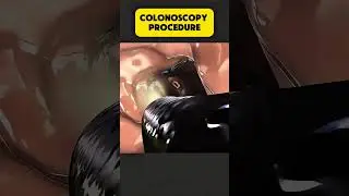 Colonoscopy procedure #Colonoscopy #invasiveprocedure #medicalworld #treatment#shorts