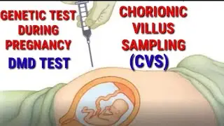 Muscular dystrophy prenatal diagnosis - chorionic villus sampling (CVS) @mdresearch