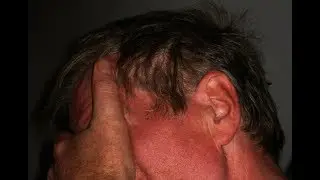 Erythrophobia Hypnosis | Stop Facial Flushing & Social Blushing