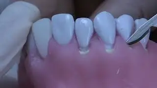 Achieve Multiple Recession Coverage Around Teeth via TCAF With Soft Tissue Substitute-Model  part1