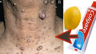 Remove Skin tags Overnight | Amazing remedy to remove skin tags fast