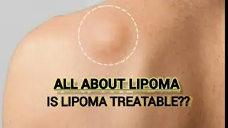 Lipoma (Fatty lump) | Lipoma Treatment 👍