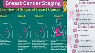 Breast Cancer