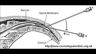 Why Caudal anaesthesia will stop pain of cervical dilatation but not pain of uterine contraction