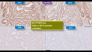 Microsatellite Instability (MSI) and Mismatch Repair (MMR) Deficiency Lecture