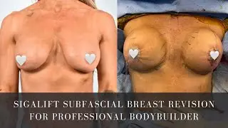 Sigalift Subfascial Breast Revision for Professional Bodybuilder