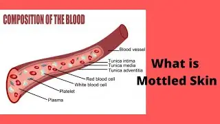 What is Mottled Skin