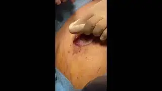Grade 2 Gynecomastia Surgery with Periareolar Lift: Video Footage