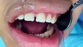 How To Achieve Perfect Smiles:Teeth CLEANING ProCEDURE Dental Therapist Explain|#yt #teethwhitening