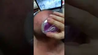 Reverse hair loss naturally, without Rogaine or minoxidil