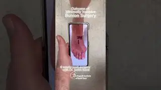 6 Weeks After Minimally Invasive Bunion Surgery. Fast Recovery with Dr. Kane at OINT