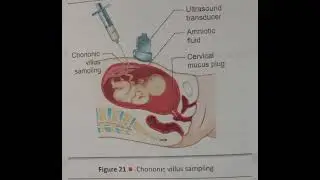 SCREENING TESTS DURING PREGNANCY (AMNIOCENTESIS CHORIONIC VILLUS SAMPLING CORDOCENTESIS)#nursing #tr