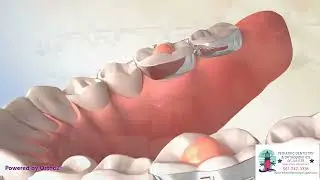 Molar build ups