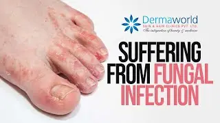 Suffering from Fungal Infection #shots Dr. Rohit batra