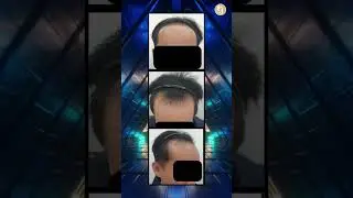 M-shape Transplant  #baldnesssolution #fuehairtransplant #fue #hairloss #hair #hairlosscure