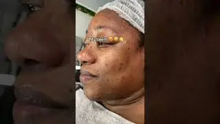 Bio Peeling Client Journey | Chemical Peels London | Skincare Treatment