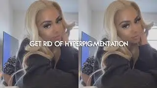 — GET RID OF HYPERPIGMENTATION :: SUBLIMINAL ᥫ᭡
