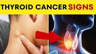 10 Warning Signs of Thyroid Cancer | Early Detection for Better Health