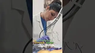 Stretch marks treatment by Dr Sonia Mangal #fractionalco2laser #stretchmarksremoval #scars #laser