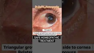 क्या आपकी भी आंख में ये समस्या है?#homeopathicmedicine #homeopathy #shorts #viral