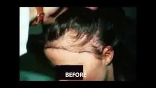Toronto Hair Transplant Surgeon Call (416) 322-0390 For Hair Transplant Doctor