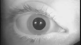 Nystagmus horizontal droit lors de la man&oelig;uvre diagnostique de Dix-Hallpike (VPPB)