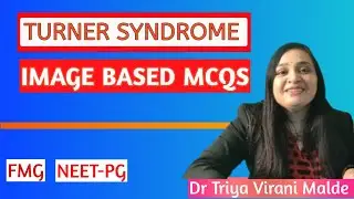 Turner Syndrome MCQs and Mnemonics - Image based MCQs For NEET PG , Medical Entrance Exam