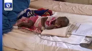 Nearly Half Of The Death In Children Under 5 Years Of Age Are Linked To Malnutrition In Yobe State