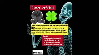 Clover leaf skull #Radiology#