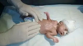 Soft Touch, Big Progress: Gentle Physiotherapy for a Preterm Baby in NICU
