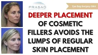 Avoiding Lumps on the Skin from Cosmetic Fillers by Placing Them Deeper with the Y Lift&reg;