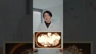 Онкология и профилактика рака с помощью IV-терапии