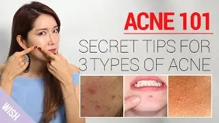 Acne 101: How to Take Care of Acne At Home (Types & Treatment) | Wishtrend