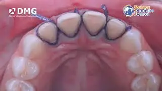 HONIGUM PRO