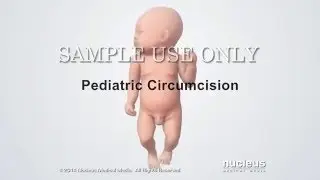 Circoncisione