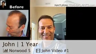 Hair Transplant Transformation After 1 Year by Dr Matt Huebner | Hair Transplant Results  (John)