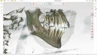 Exclusivit&eacute; Spark : superposition de l'Approver dynamique sur le CBCT complet