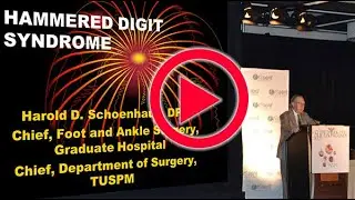 PRESENT Podiatry  - Schoenhaus Hammered Digit Syndrome