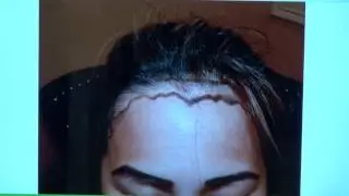 Asian Woman Frontal Hairline Restoration in California by Dr.Diep  http://www.mhtaclinic.com