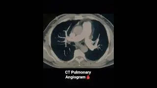 CT Pulmonary Angiography 🫁#ctscan #ctpa #angio #angiogram #anatomy #radiology #radiographer