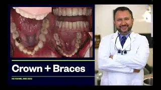 Dental Crown, Braces