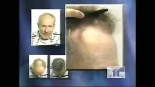 Dr Seager Hair Transplant Center Commercial Early 2000s