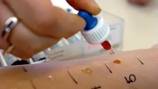 Allergietest: So funktioniert er