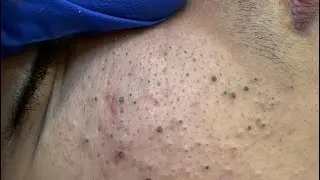 [ASMR] Deep Facial Cleansing and Pore Unclogging Routine