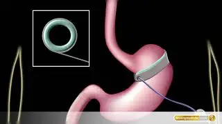 Magenband: Adipositas-Chirurgie