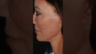 MIND-BLOWING Neck Lift Results Revealed by Surgeon