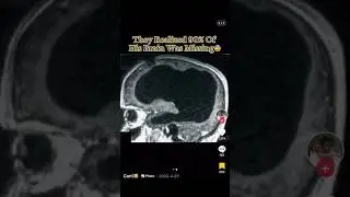 They Realized 90% Of His Brain Was Missing ☠️ #interesting