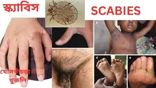 স্ক্যাবিস/ SCABIES #health #medicine #education #medicalstudent #nursingstudent #quake2remastered 