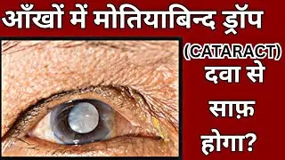 What Is Cataract? Symptoms, Causes, Myths & Best Treatment Explained by Eye Doctor