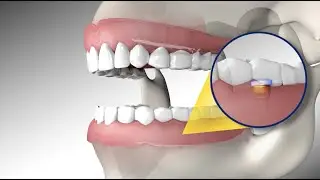 Locked In & Ready to Go | Renew Anchored Dentures